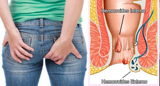 Illustration for article titled Penyebab Penyakit Wasir dan Cara Mengobatinya